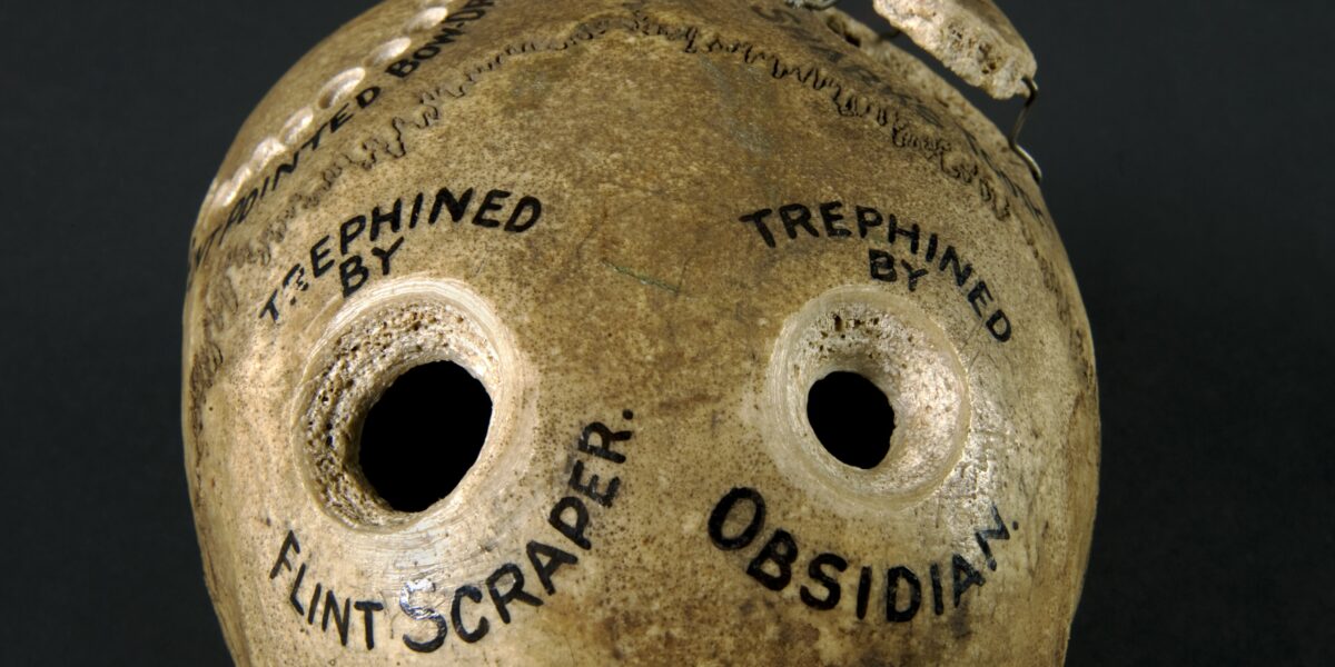 Human skull illustrating different methods of trephination o Wellcome L0058796