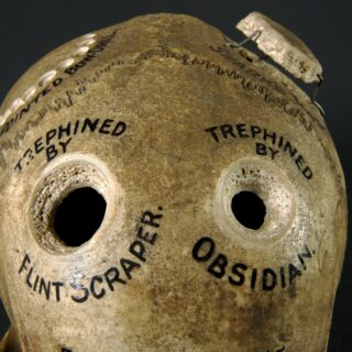 Human skull illustrating different methods of trephination o Wellcome L0058796